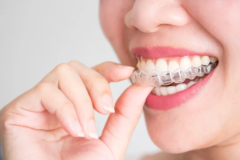 Life After Invisalign: Maintaining Your Beautiful Smile