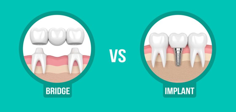 Choosing Between Dental Implants and Bridges: What Works Best for You?