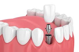 Why Implants Protect Adjacent Natural Teeth