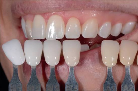 The Art Of Shade Matching For Multigenerational Restorations