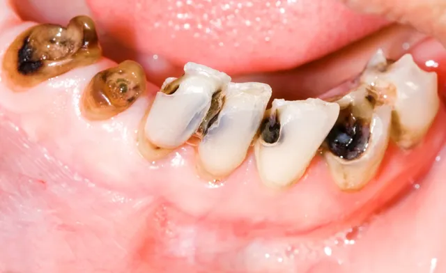 4 Signs A Dental Problem May Be Affecting Your Eating Habits